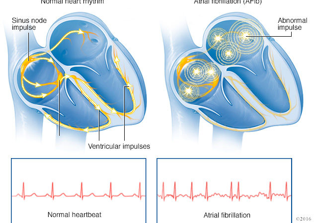 Канадские медики объясняют причину сердечной аритмии
